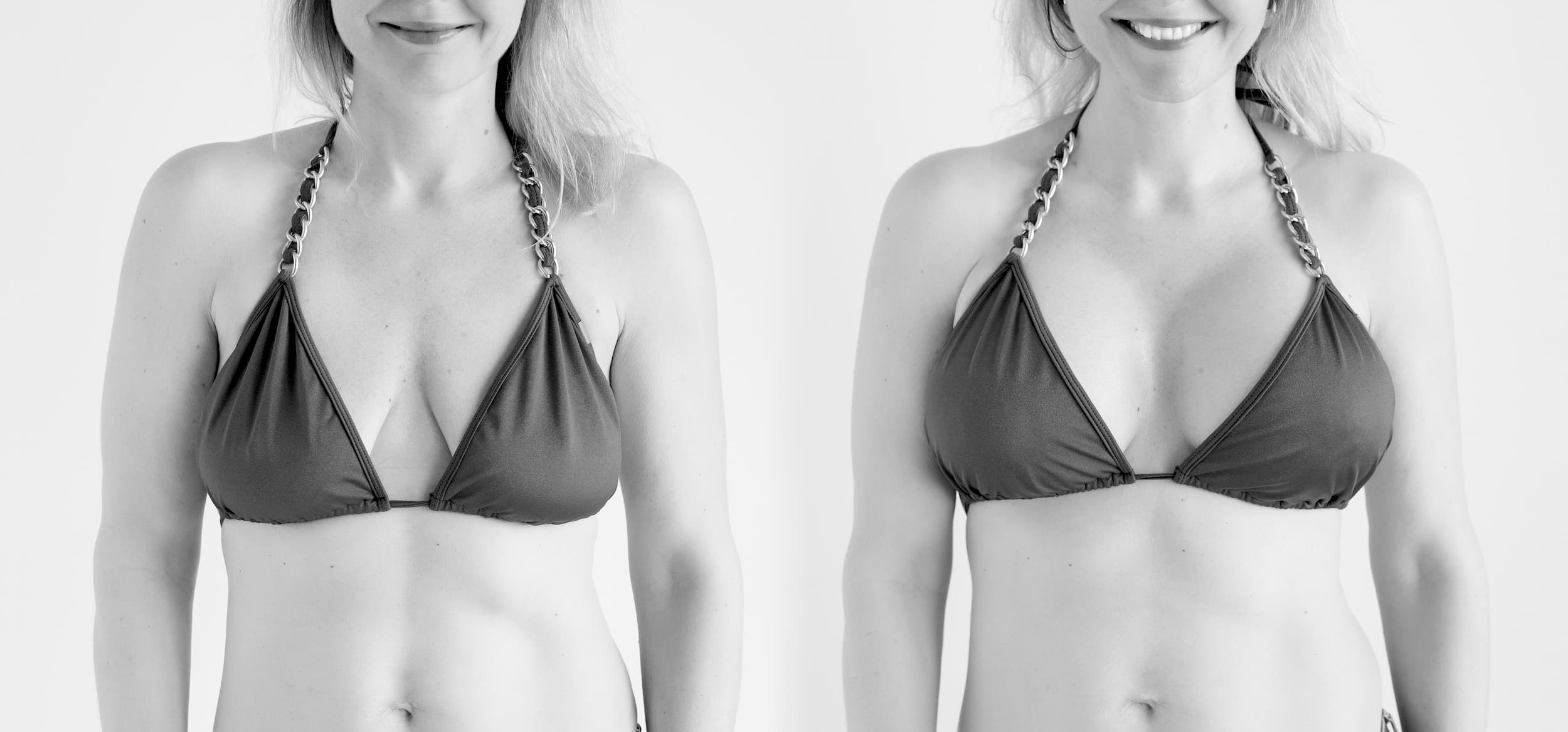 before and after photo of a woman's breasts