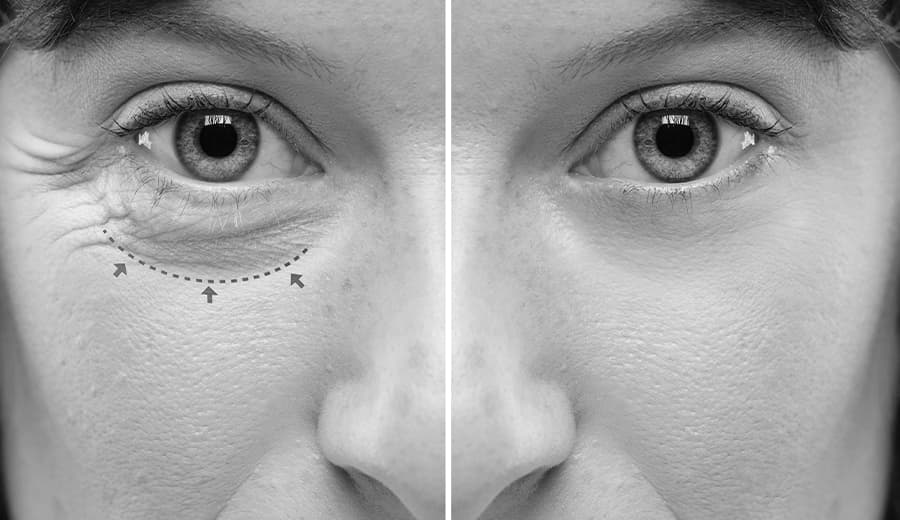 before and after image of woman's eyes
