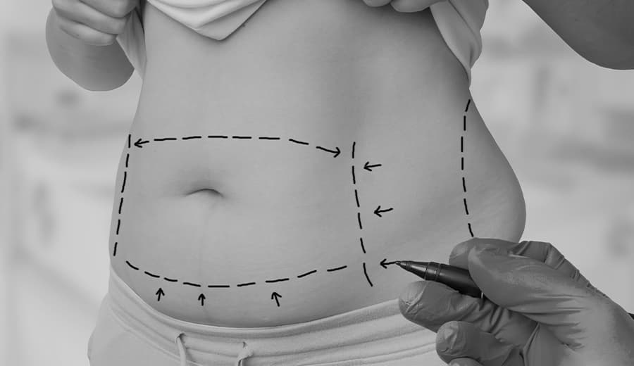 7 Rules For How To Reduce Swelling After Tummy Tuck Surgery