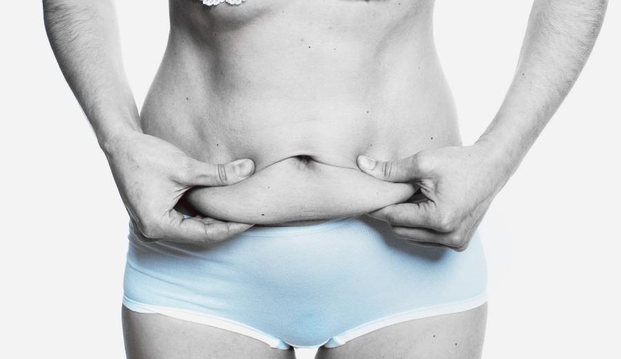 Panniculectomy vs Tummy Tuck