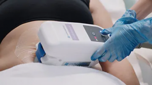 CoolSculpting