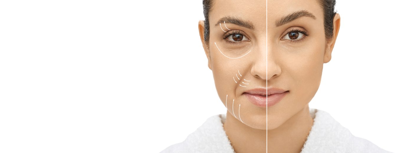 Woman's face before and after skin tightening and anti-aging procedures.