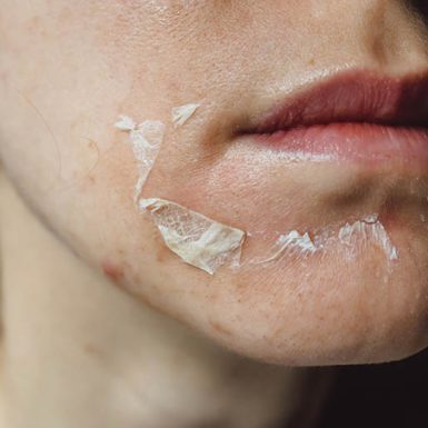 Chemical Peel Recovery Process banner