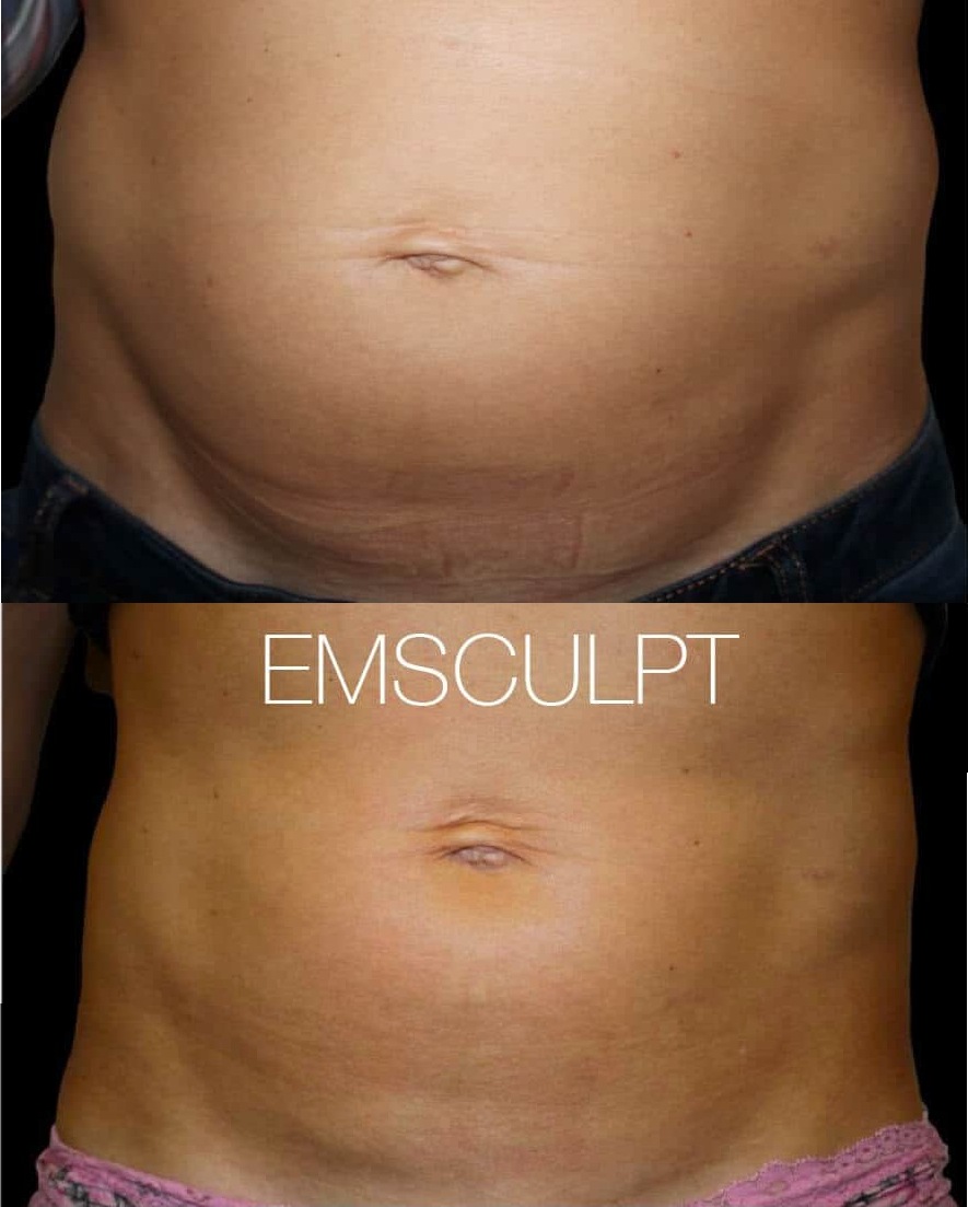 EMsculpt Treatment in Toronto - See Our Before & Afters!