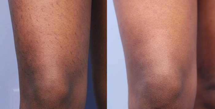 Before and after comparison of laser hair removal on legs.