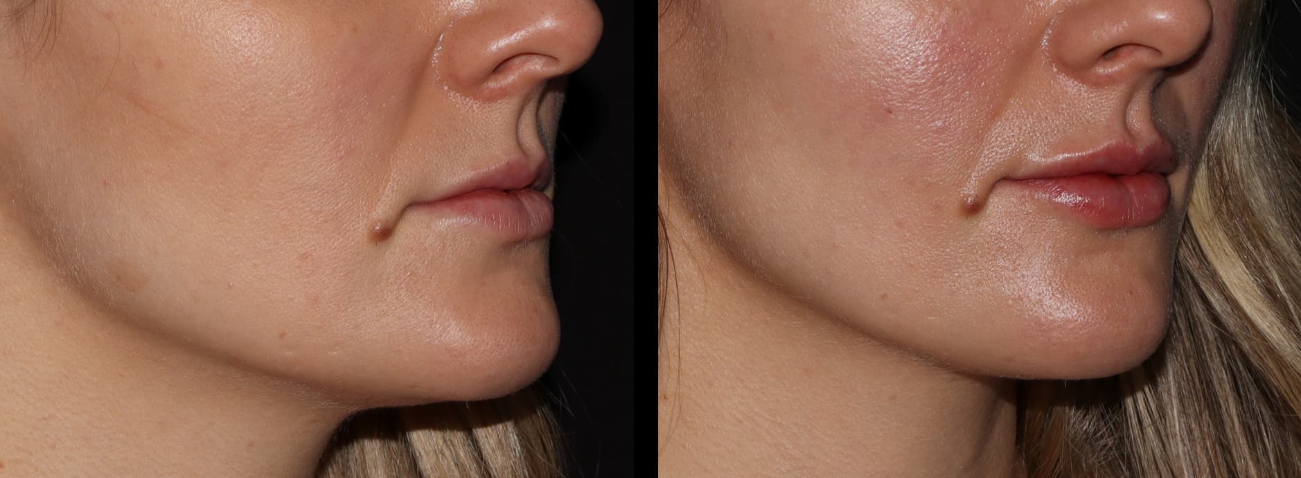 lip fillers toronto