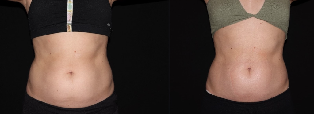 CoolSculpting in abdominal region: Before & After 