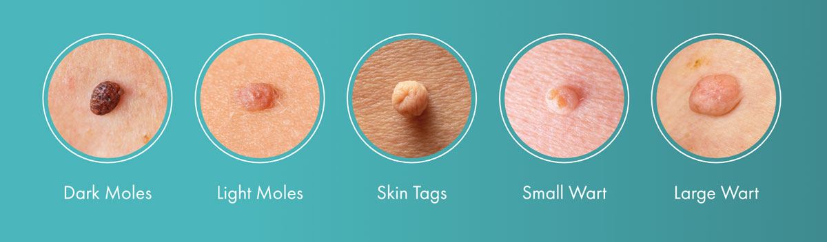 Warts vs. Moles vs. Skin Tags
