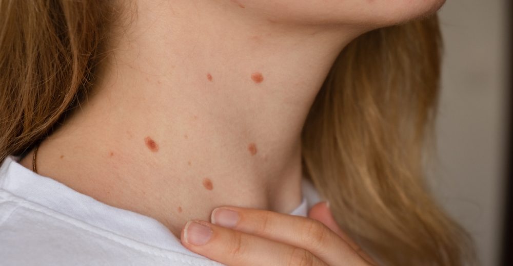 Woman showing her birthmarks on neck skin.