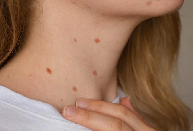 Woman showing her birthmarks on neck skin.