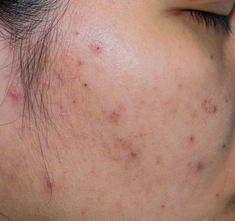 post acne hyperpigmentation