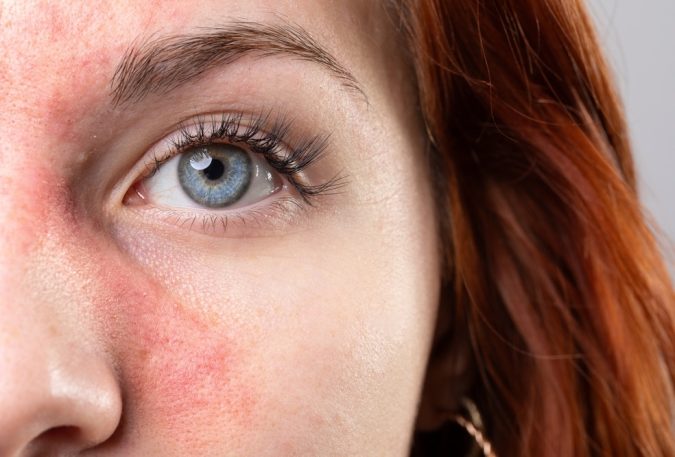 Close-up of a woman’s face showing redness and inflammation characteristic of rosacea.